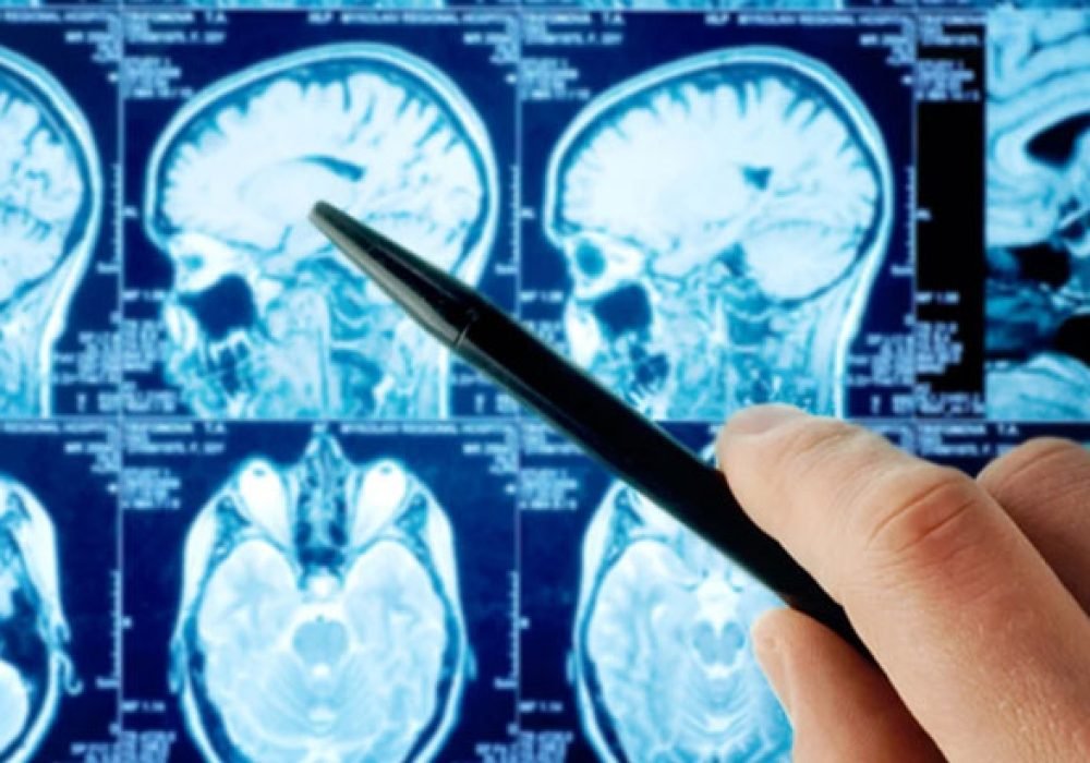 Brain-Tumor-1